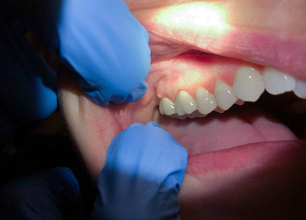 Best Emergency Wisdom Teeth Removal in Lowellville, OH